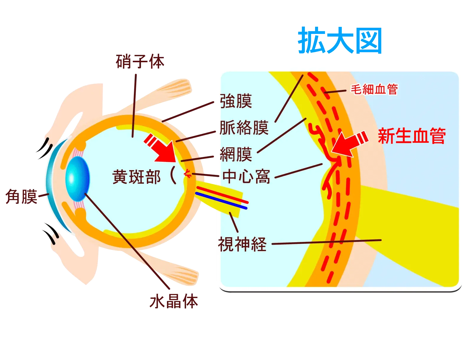 加齢性黄斑変性症