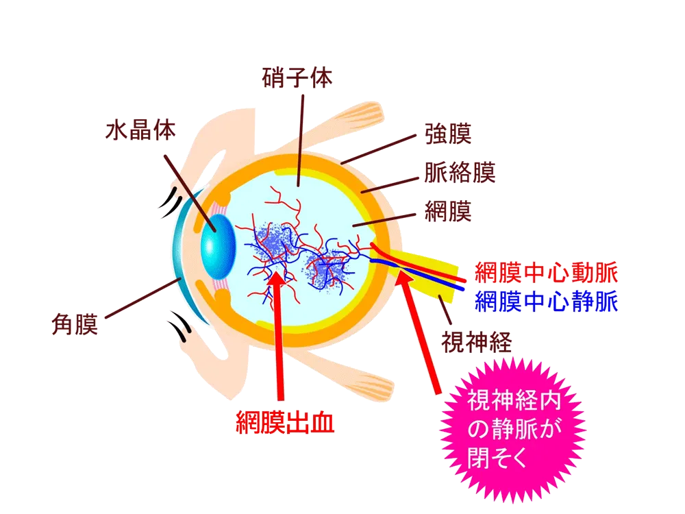 網膜中心静脈閉そく症